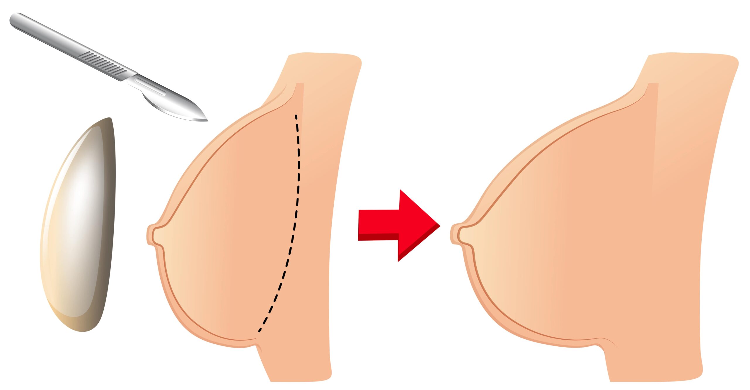 Breast Surgery