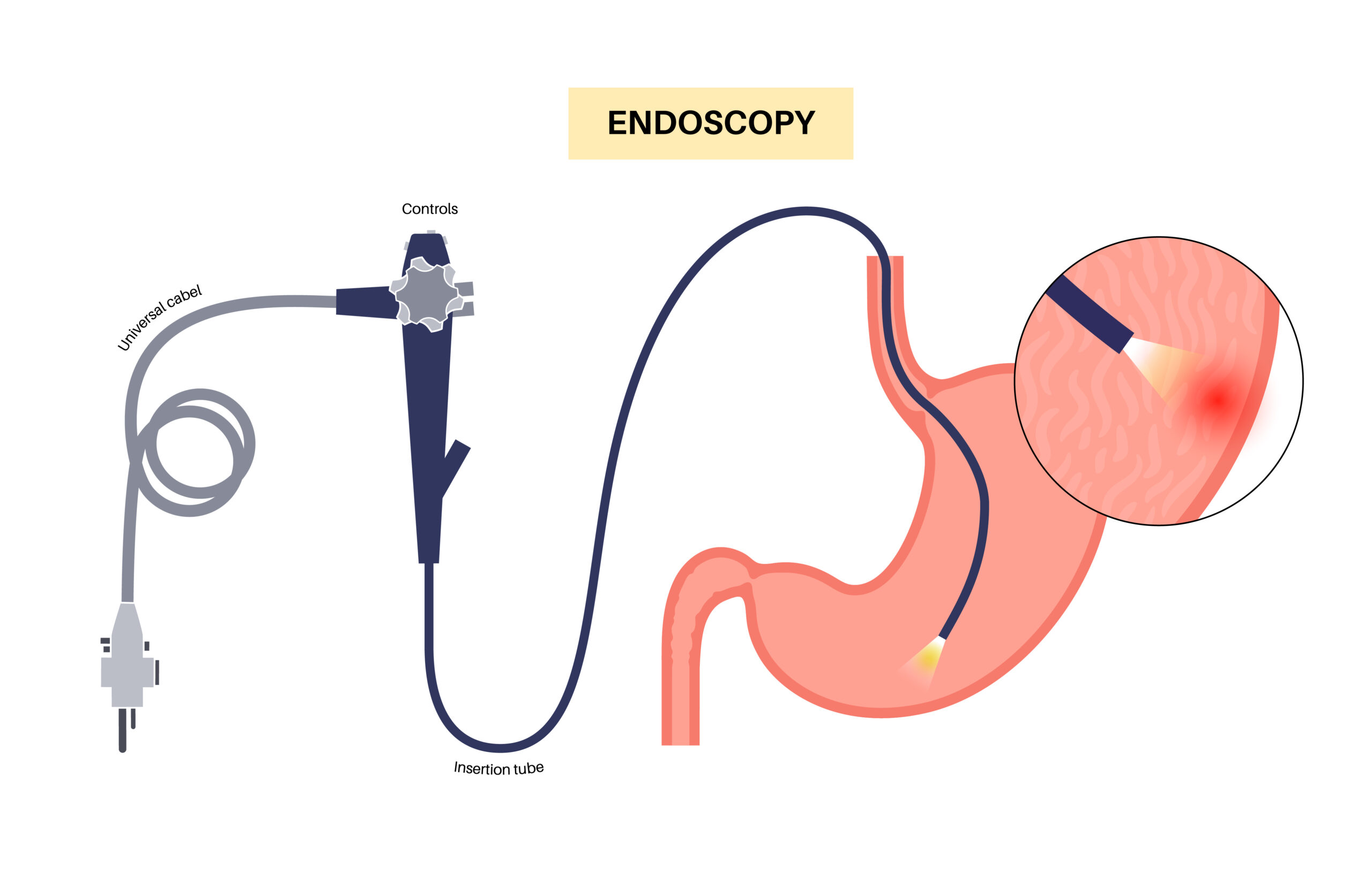 Gastroscopy