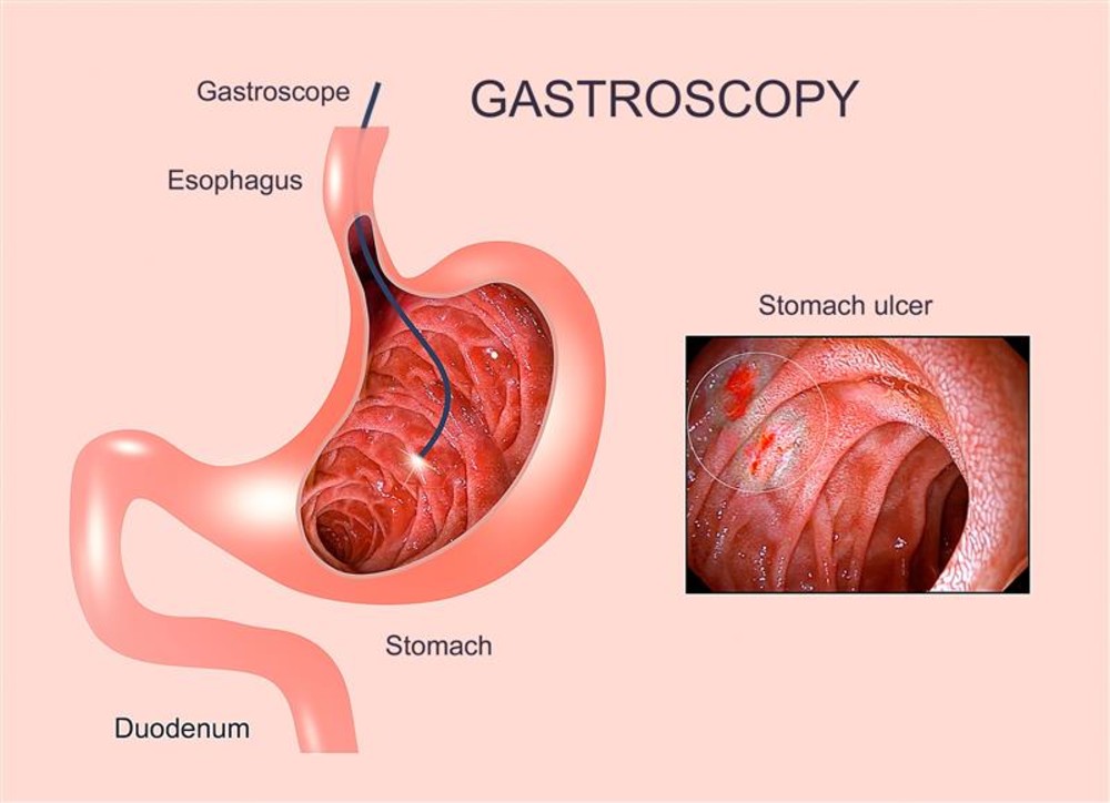 Gastroscopy